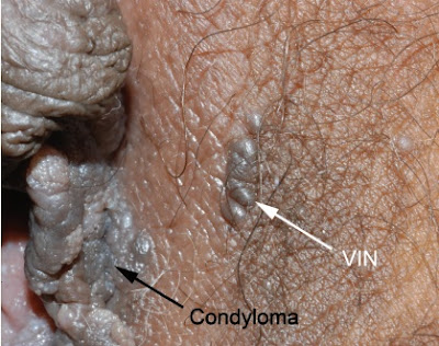 Nodular pigmented lesions of vulvar intraepithelial neoplasia