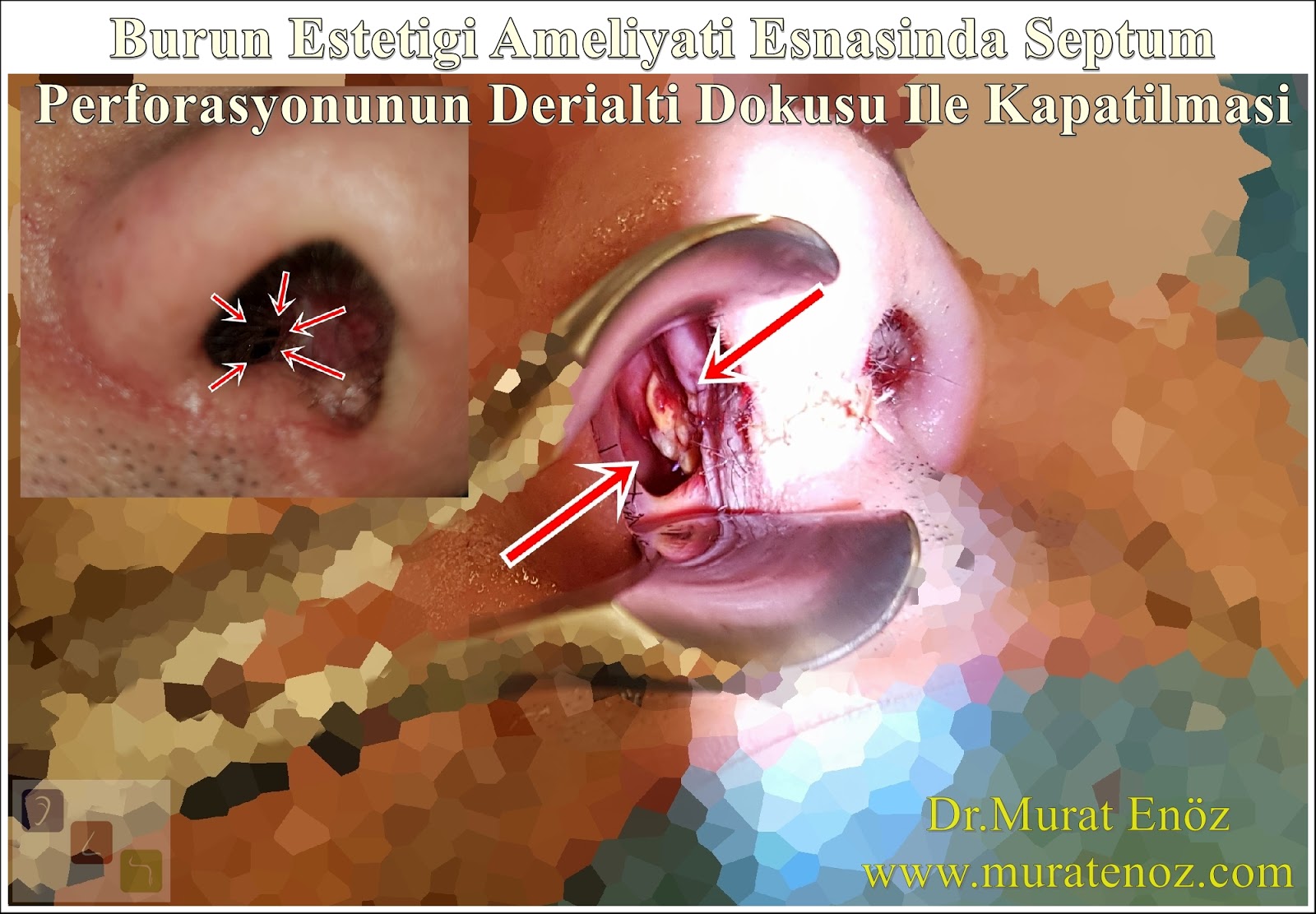 Burun Estetigi Ameliyati Esnasinda Septum Perforasyonunun Derialti Dokusu Ile Kapatilmasi