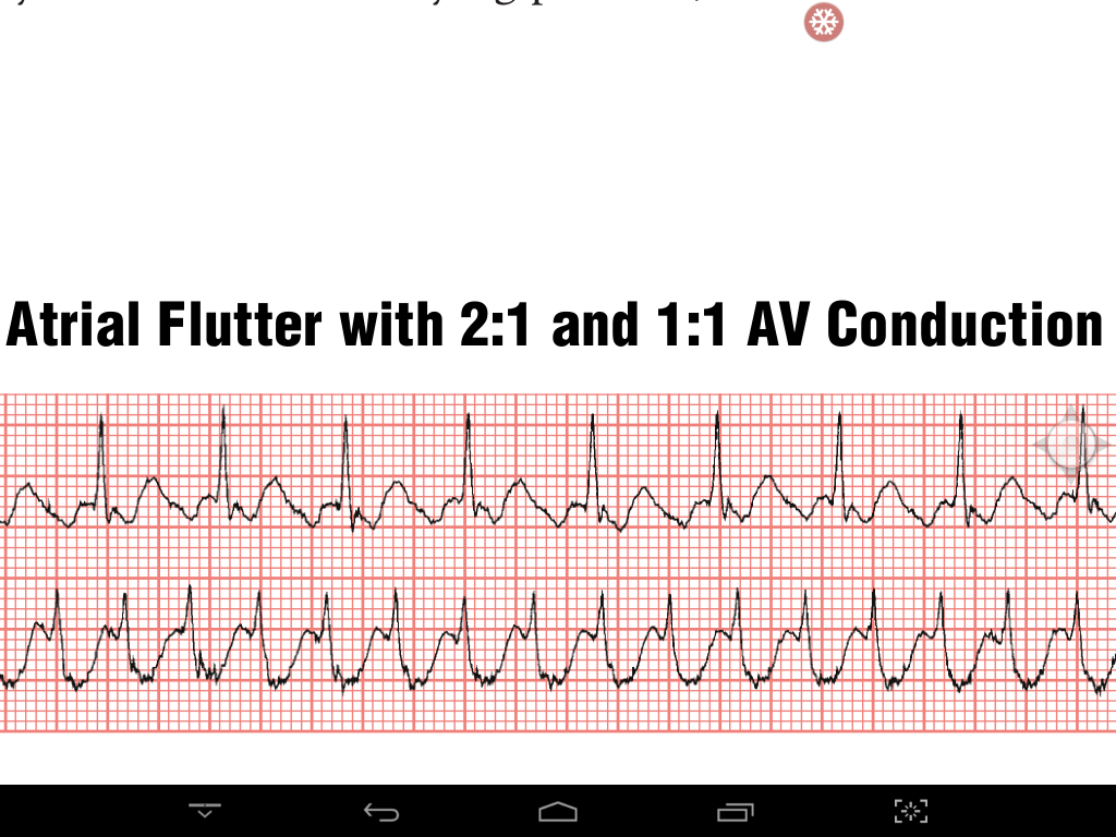 Atrial Flutter With Exercise Induced 11 Atrioventricu - vrogue.co