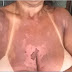 QUATRO MULHERES DENUNCIAM CLÍNICA POR QUEIMADURAS DURANTE BRONZEAMENTO NATURAL COM FITAS NA BAHIA
