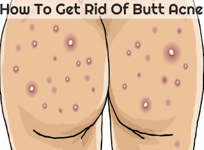How to Get Rid of Butt Acne