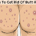 How to Get Rid of Butt Acne Fast