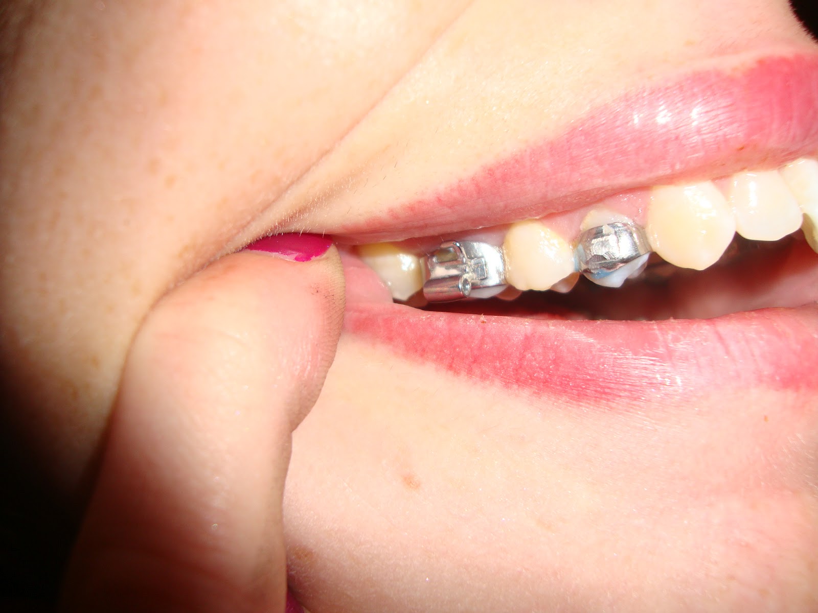 23 Year Old Brace Face September 2012