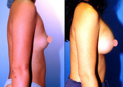 silicone nos seios antes e depois silicone nos seios antes e depois