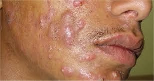 comment soigner nodule visage