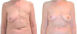 Augmentation mammaire avant après pour femme
