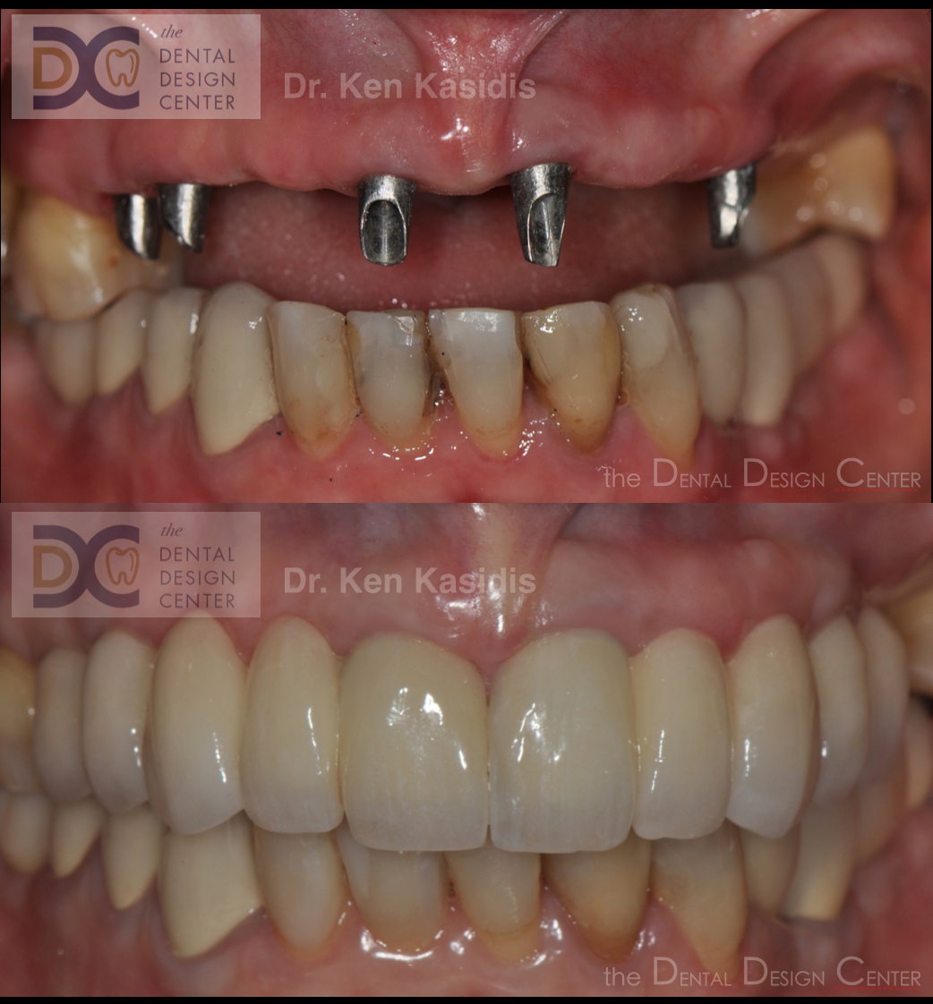 Anterior dental implants Dental Design Center Dental Clinic Pattaya