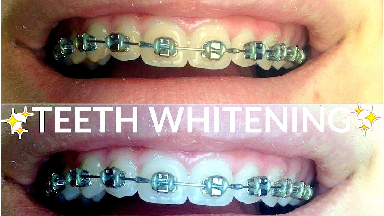How To Make Your Teeth Whiter With Braces White Choices