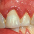 Mẹo chữa viêm lợi chân răng an toàn tại nhà