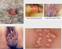 Rekomendasi Obat Ampuh Menyembuhkan Kutil Kelamin Di Apotik Umum Rekomendasi Obat Ampuh Menyembuhkan Kutil Kelamin Di Apotik Umum