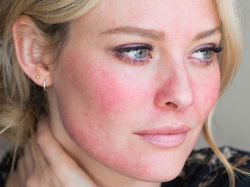 Como Eliminar La Rosacea Con 4 Remedios Naturales Rosacea Tratamiento