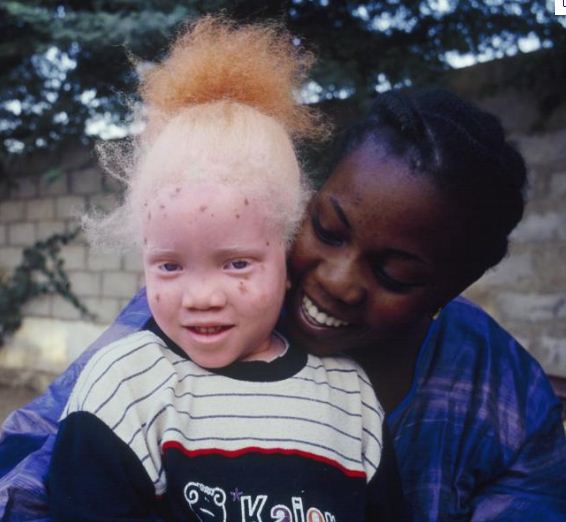 DIASPORA IVOIRIENNE MONTPELLIER: TELE France 5 : Albinos d'Afrique ...