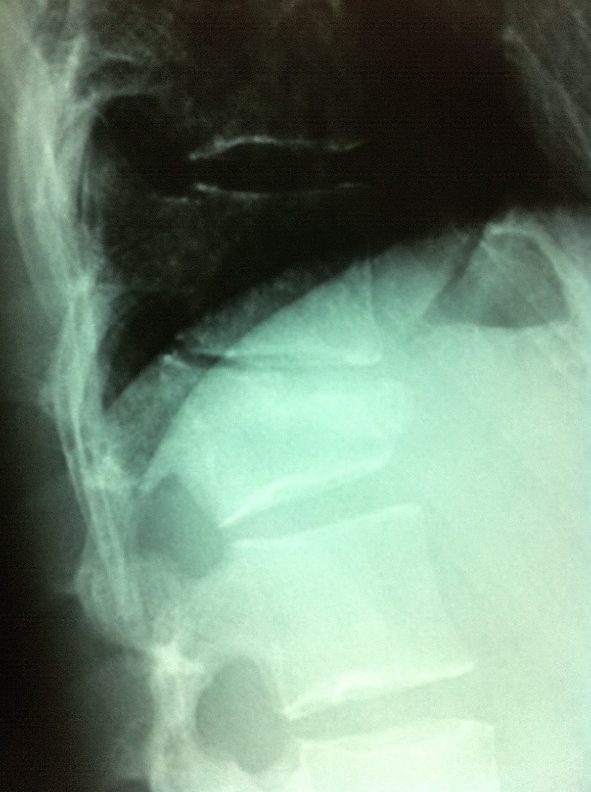 stories a broken back may 2012 stories a broken back may 2012