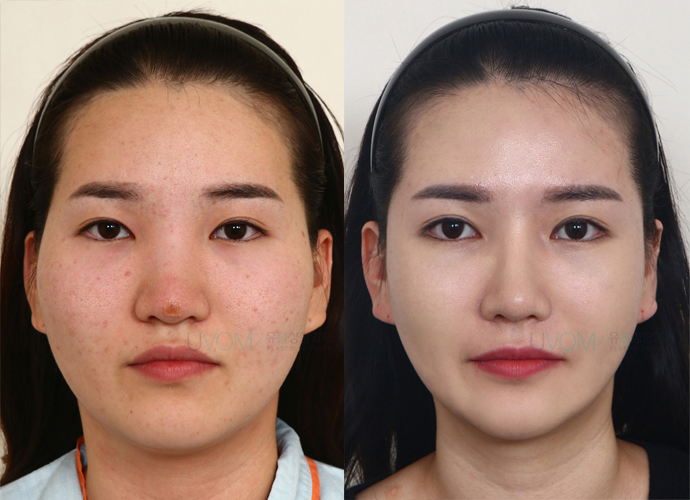 UVOM Plastic Surgery Face Contouring Before and After