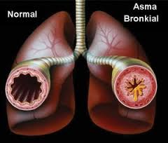 penyakit asma bronkial penyakit asma bronkial