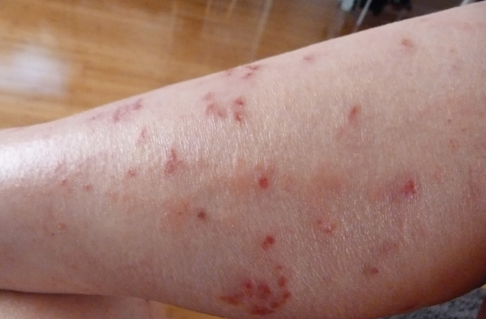 Photos of Eczema on Adults Legs Treatment for Eczema Remedies for Eczema Atopic Dermatitis