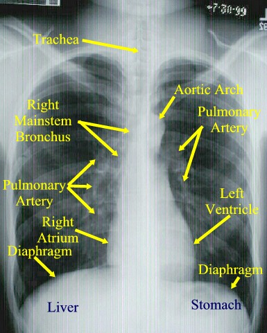 Respiratory Therapy Cave: Tips for reading chest x-rays