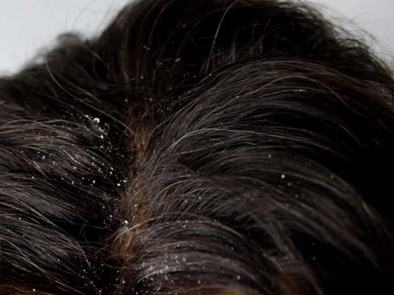 How To Get Rid Of Dandruff, How To Remove Dandruff, Home Remedies For Dandruff, Dandruff Treatment, Dandruff Remedies, Treatment For Dandruff, Dandruff Home Remedy, Dandruff Causes, Causes Of Dandruff, 