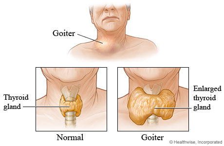 Pembengkakan kelenjar tiroid yang dinamakan goiter.