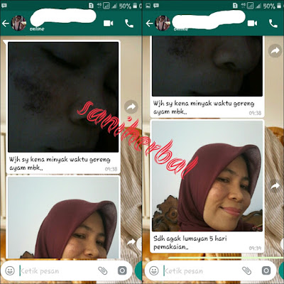 Cream Pemudar Flek Hitam Terbaik Cream Pemudar Flek Hitam Terbaik