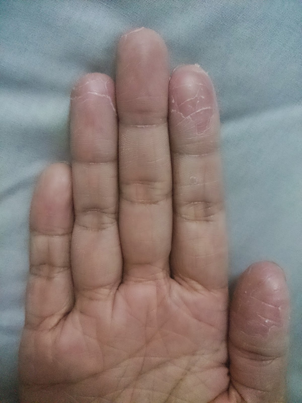 Coping with Ichthyosis 11122014 Skin allergy