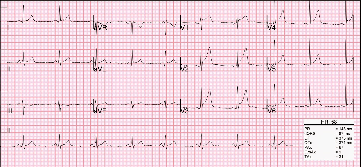 Тяжелое экг. V4 v5 v6 на ЭКГ. ЭКГ электрокардиограмма сердца. Нижний STEMI на ЭКГ. Снимок ЭКГ У здорового человека.
