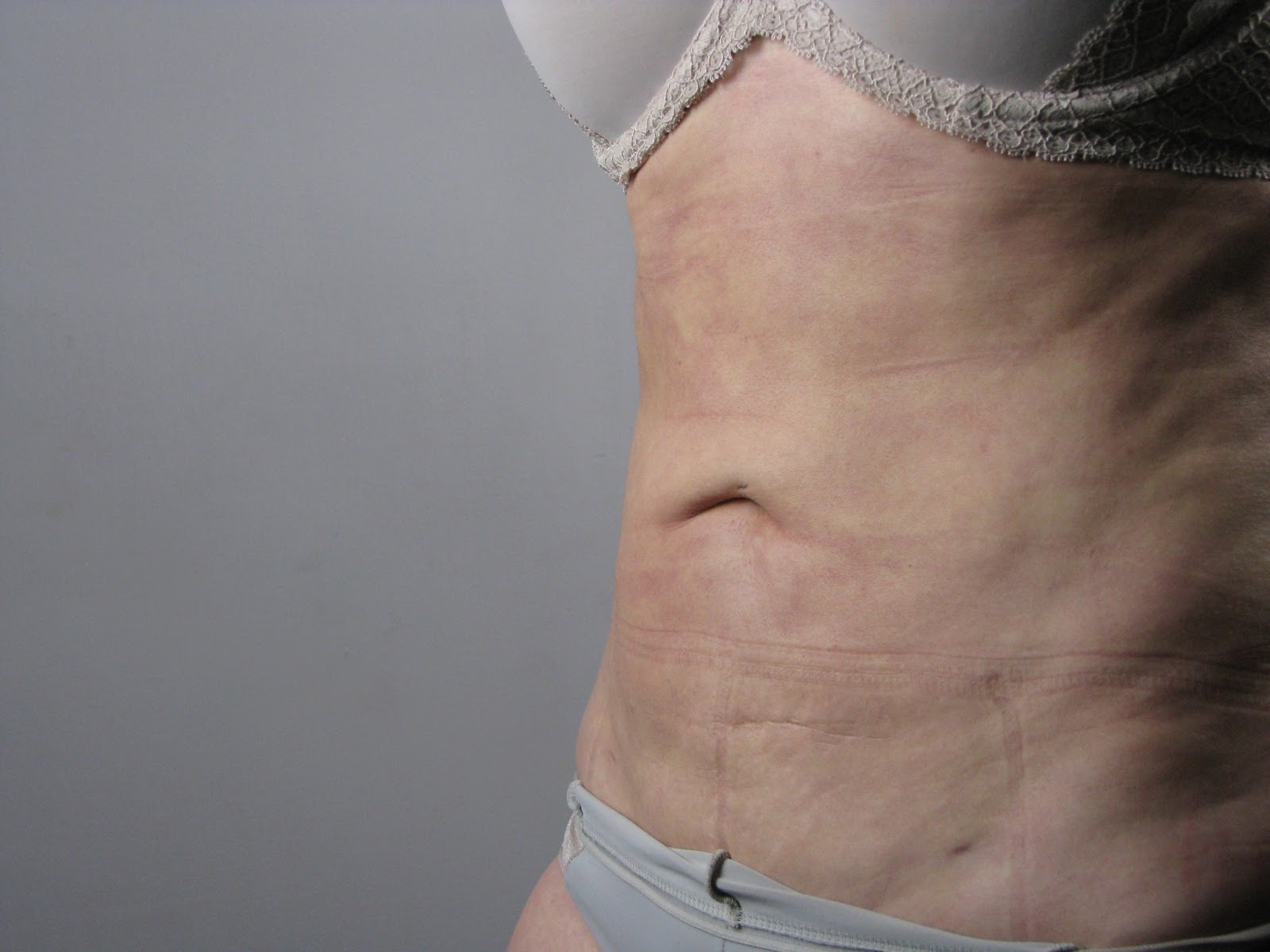 Selston Cosmetic Clinic Female Abs..Vaser Lipo..Before and After