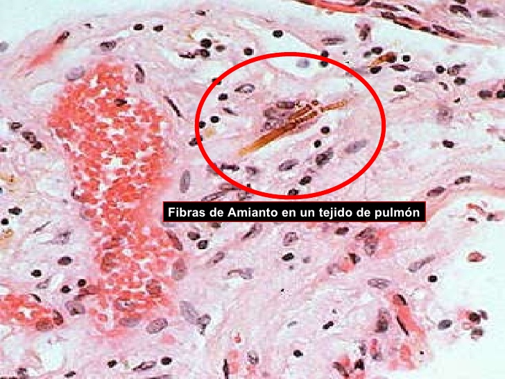 lamianto causa il cancro alla prostata