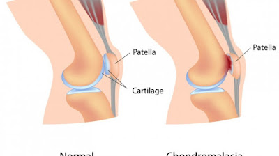 kondromalacia, chondromalacia, nyeri lutut depan