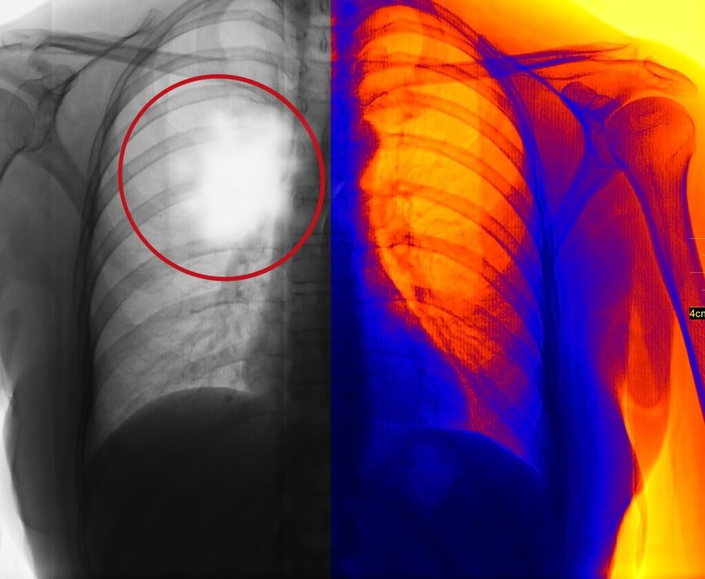Mesothelioma Cancer Attribution Rate Mesothelioma Cancer Attribution Rate