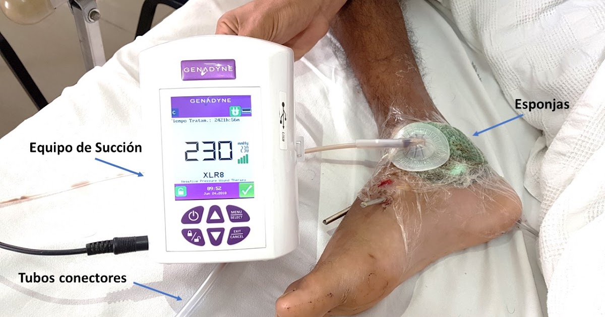 Curso de Cirugía Plástica CiruplasMedia Terapia de Presión Negativa (TPN)