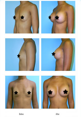 silicone nos seios antes e depois silicone nos seios antes e depois