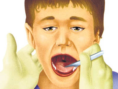 Tonsillectomy adult risk Tonsillectomy adult risk thanks