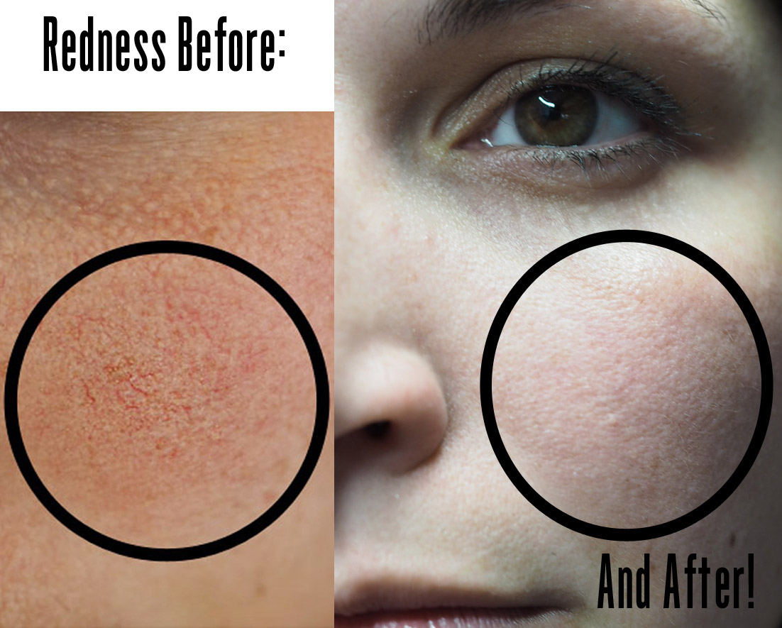 Review (with pictures) Excel V Laser for rosacea treatment and facial