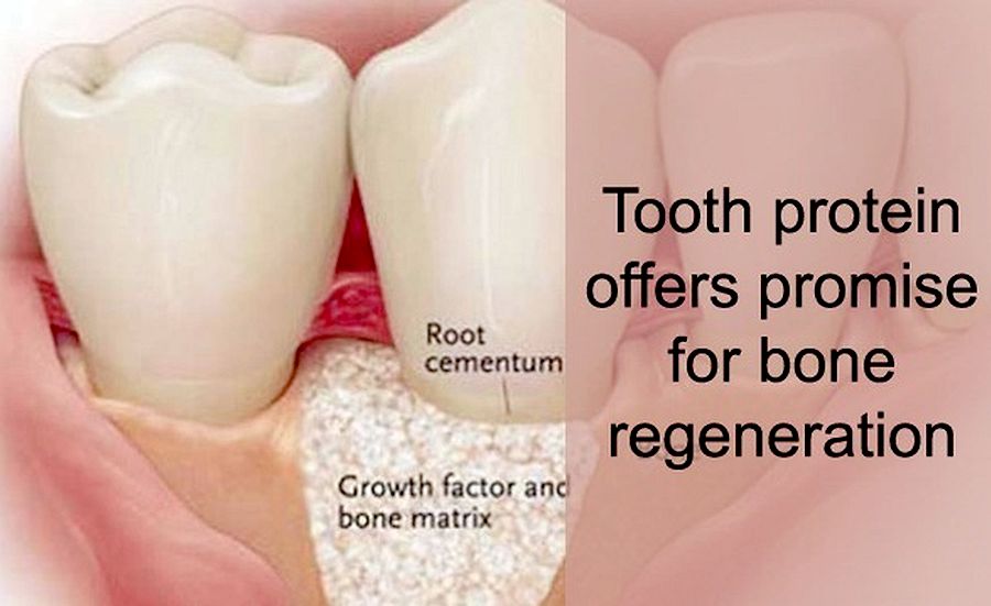 DENTAL NEWS Tooth protein offers promise for bone regeneration