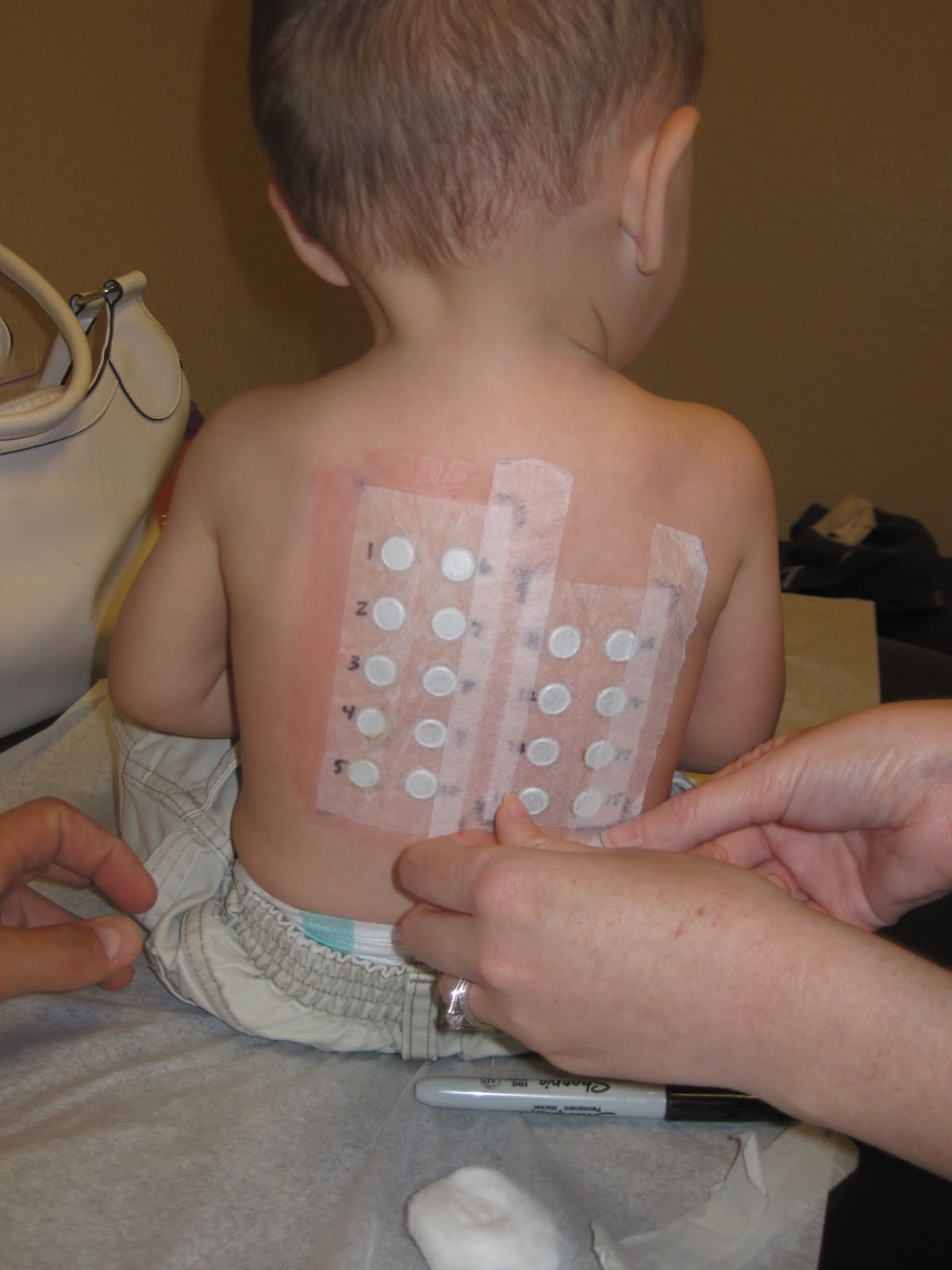 Tyler c with ee patch test results