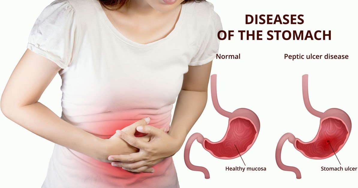 Gastritis Maag Madu Asli High Desert