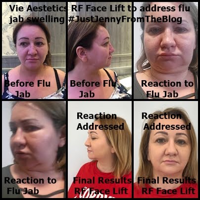 Vie Aesthetics RF Face Lift to address facial lumps, swelling & pain caused by the flu jab