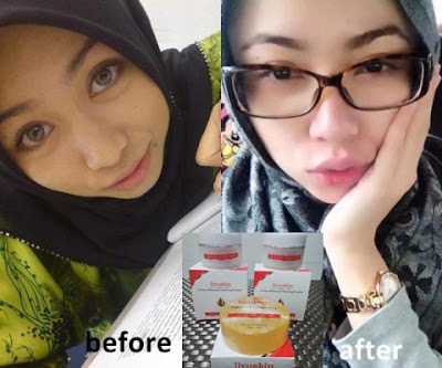Cream Wajah Untuk Mengatasi Hiperpigmentasi Liyoskin Cream Wajah Untuk Mengatasi Hiperpigmentasi