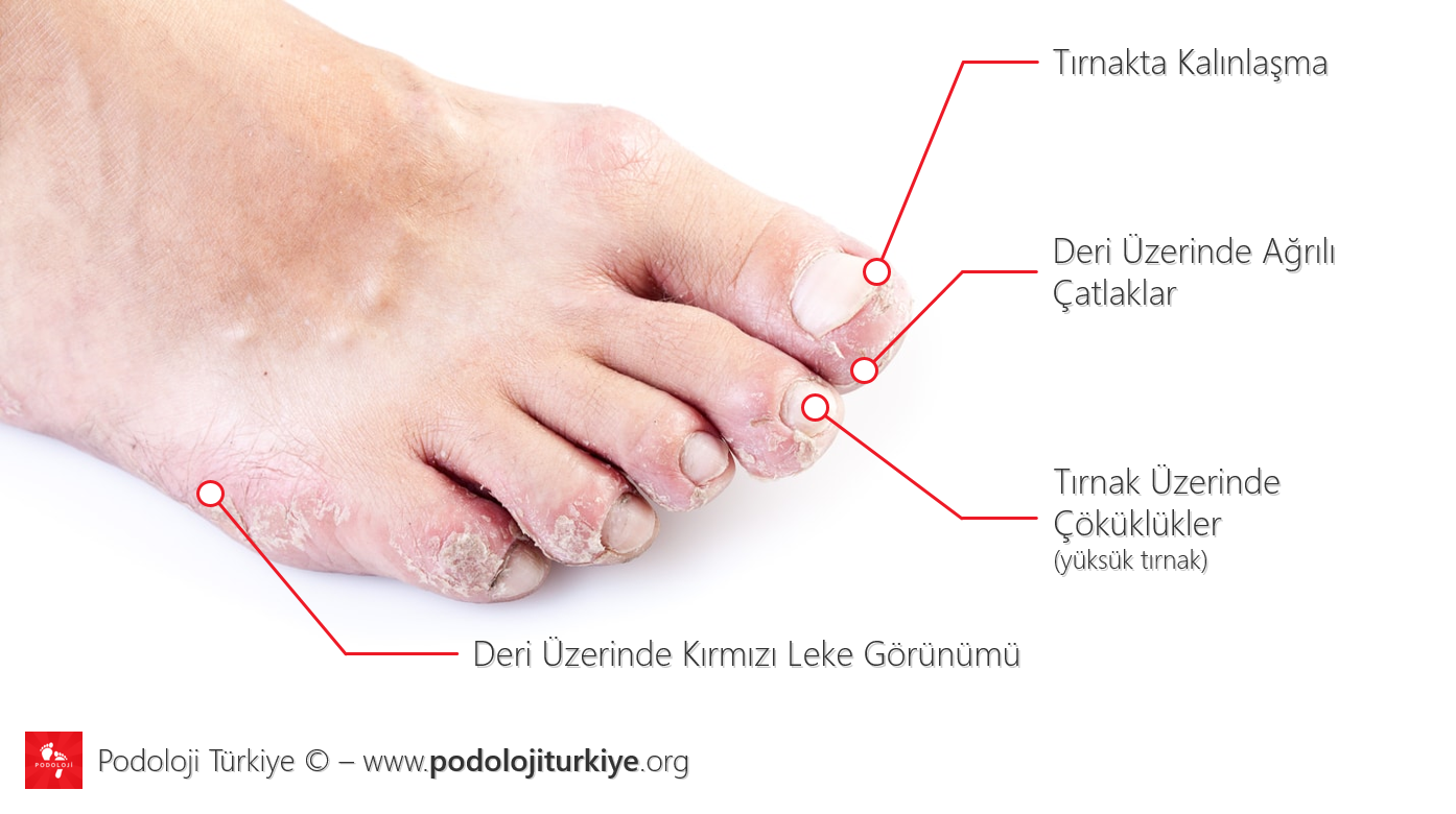 Palmoplantar Psoriasis (Sedef Hastalığı) Nedir?