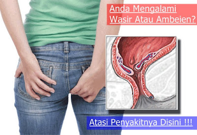 Foto Obat wasir tidak berdarah keluar benjolan dari anus