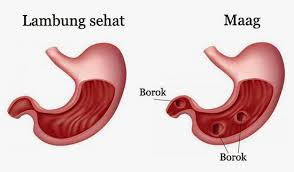 pengobatan alternatif maag akut