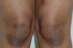5 Materi Alami Untuk Bersihkan Lutut Gelap Dan Kasar