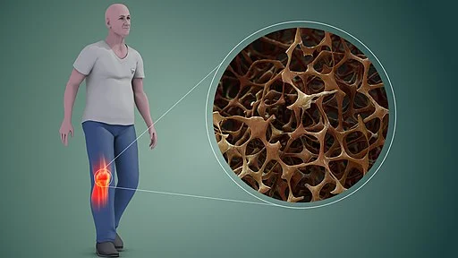 Mencegah Osteoporosis