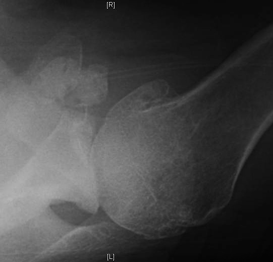 Shoulder Arthritis/Joint Replacement Rotator cuff tears Rock climbing