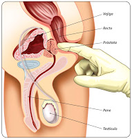 permixon para la prostata