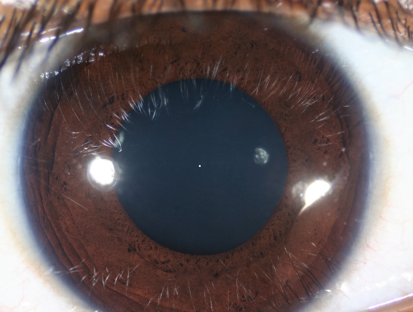 Modern & Multidimensional Iridology: Crypt & Collarette Structure - Rx ...