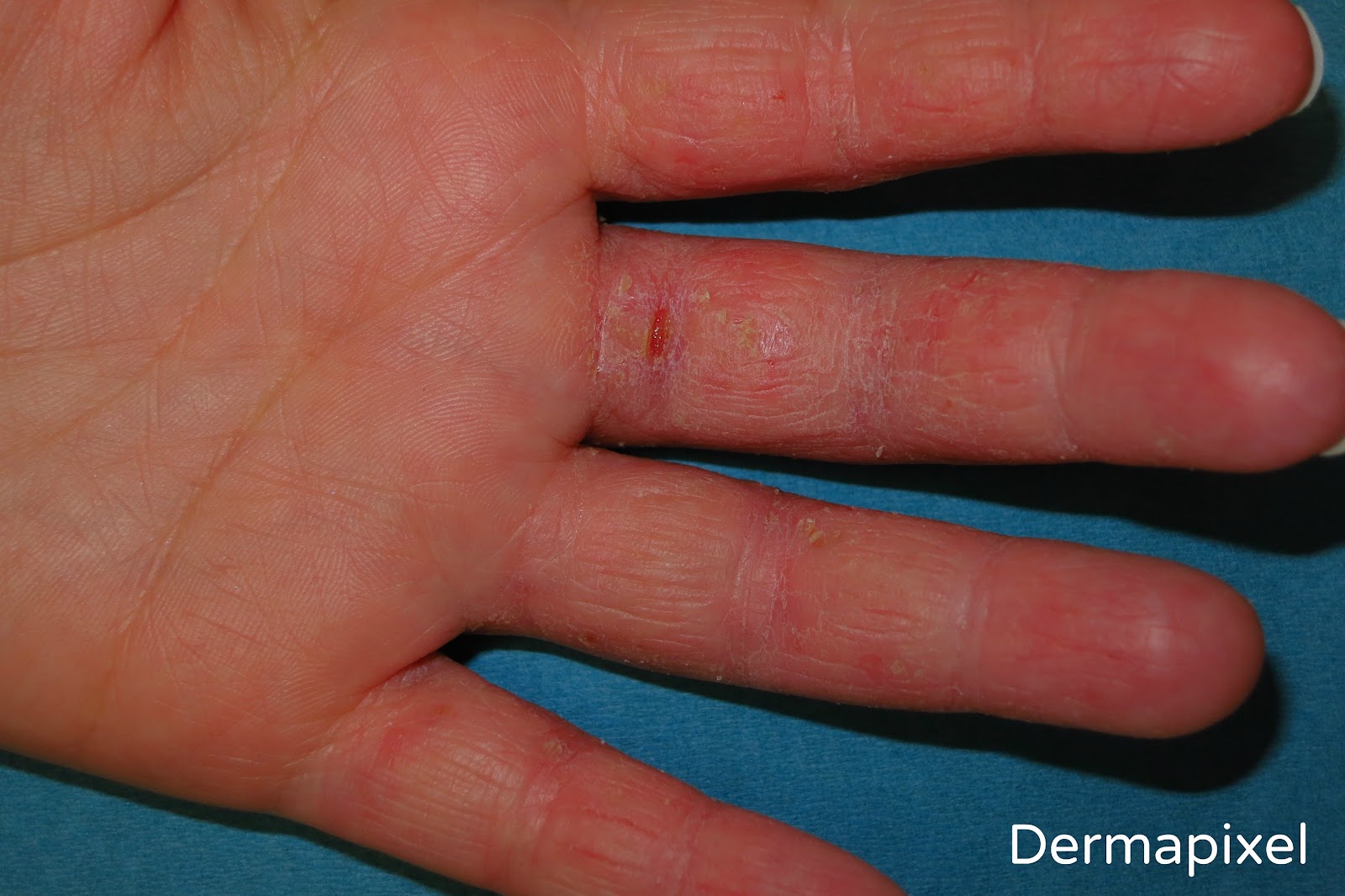 extraño Recuperar Robar a Dermapixel: Me pican las manos