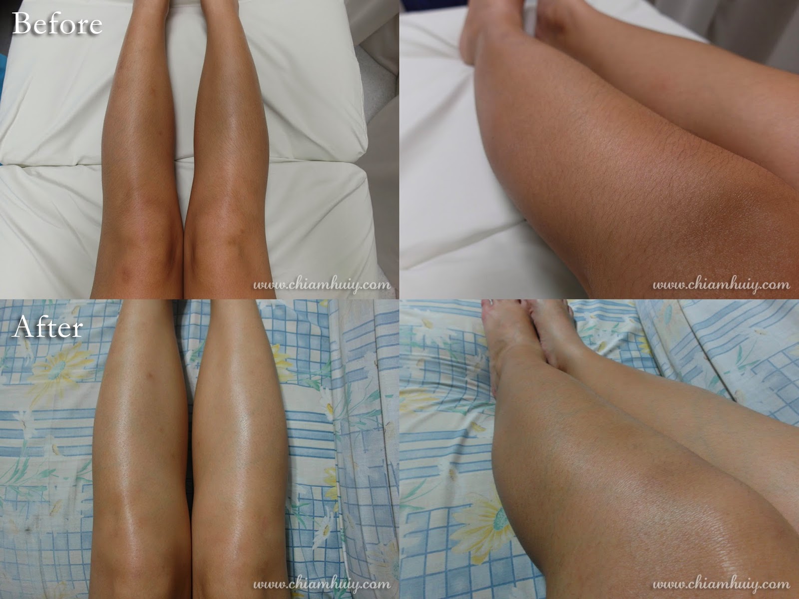 Laser Hair Removal Review FAQs Aesthetics And Hair Clinic