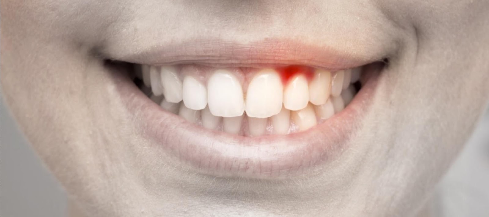 Gengive rosse e sanguinanti come intervenire? Dott. Massimo Buda